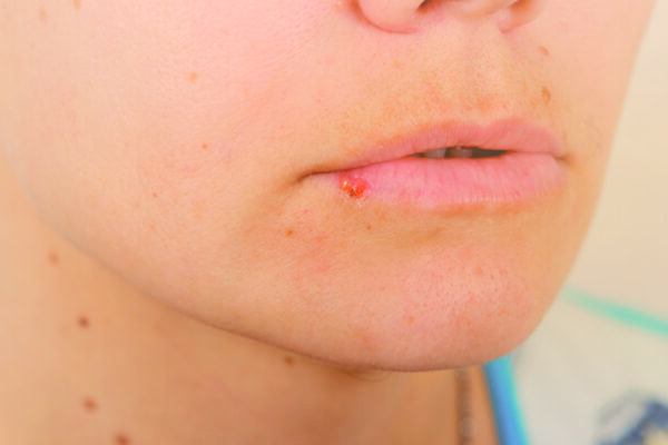 O herpes e o diabetes