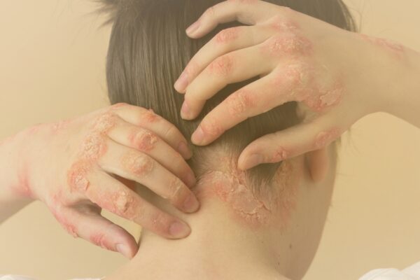 A relação da psoríase com a poluição do ar